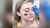 Botox Injections for TMJ Disorder by Dr. Timothy Jochen
