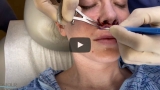 Lip Lift by Dermatologist Dr. Timothy Jochen