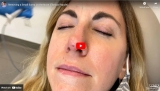 Removing a Small Fibrous Papule Bump from the Nose