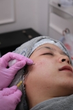 Morpheus8 Treatment Guide: Benefits, Uses, and Results | Style Vanity
