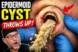This Cyst Had a MOUTH… and Then It THREW UP 🤢