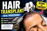 Woman’s Hairline Transplant: Real Dermatology Procedure Up Close!