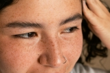 St. Louis Summer Melasma Prep Guide and Timeline