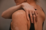 Common Eczema Triggers and Relief Options in St. Louis