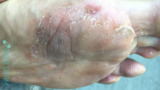 Tinea infections