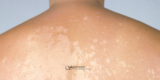 What Causes White Spots After Sun Exposure?