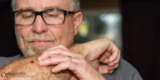 Actinic Keratoses (Precancerous Spots): Diagnosis and Treatment