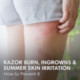 Summer Skin Irritation Prevention | Optima Dermatology
