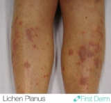 Lichen Planus – Online Dermatology