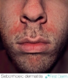 Seborrhoeic Dermatitis