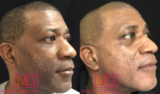 How to Remove Dark Spots on the Face