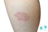 Lyme disease