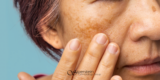Melasma: What It Is and How We Treat It