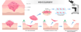Why It’s Important to Choose a Mohs Surgeon Who Is FACMS Certified