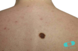 Mole (Congenital nevus)