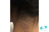 Neurodermatitis