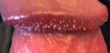 Pearly Penile Papules