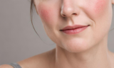 Redness? We Can Help | Pure Dermatology