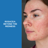 Rosacea: Beyond the Redness – Savannah River Dermatology