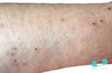 Scabies