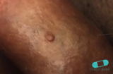 Fordyce spots