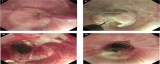 Video of the Month: Modified Peroral Endoscopic Myotomy