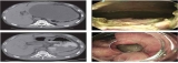 Video of the Month: Emergency Endoscopic Fenestration for Treatment of a Recurrence Pancreatic Pseudocyst