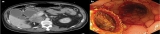 Video of the Month: EUS-Guided Choledochoduodenstomy With a Cautery-Equipped Lumen-Apposing Stent Allows Future Biliary Access in Patients With Type 2 Duodenal Obstruction