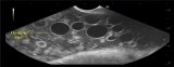 Primary Peritoneal Hydatidosis