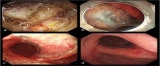 Use of PGA Sheets in the Endoscopic Closure of a Perforation After Endoscopic Submucosal Dissection for Gastric-Tube Cancer