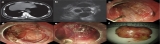 Transesophageal Endoscopic Mediastinal Tumorectomy: The First Report in a Human