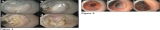 Endoscopic Pyloromyotomy for the Treatment of Severe Refractory Diabetic Gastroparesis