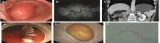 Submucosal Tunneling and Endoscopic Resection of a Huge Gastric Lipoma