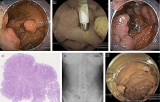 Underwater Ischemic Polypectomy for Multiple Small Bowel Polyps in a Patient With Peutz-Jeghers Syndrome