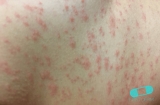 Spots and Rashes Caused by Viruses