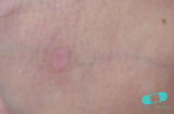 Syphilis
