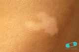 Vitiligo