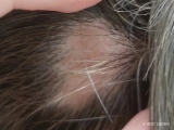 Understanding Alopecia Areata & Causes of Sudden Patchy Hair Loss