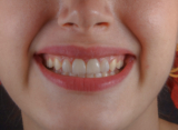 Best Snacks For Teeth | Carnivore Snax