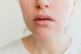 Can cold sores be cured? Dermatologist answers your burning questions