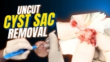 RAW & UNCUT: Massive Mushy Cyst Extraction