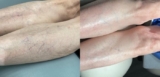 Sclerotherapy & Laser Vein Treatment Before & After Photo Gallery | Houston, TX