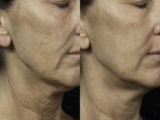 Fraxel® Before & After Photos Patient 5 | Houston, TX