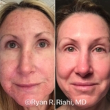 Sun Damage Treatment Before & After Photos Patient 46 | Houston, TX