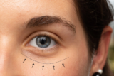 How Much Does A Blepharoplasty Cost?