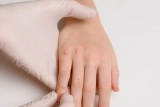 What They Look Like and How to Treat Them