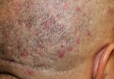 What Is Fungal Acne (Malassezia Folliculitis)