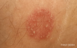 Tinea Corporis (Ringworm) –