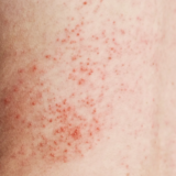 Symptoms, Causes & How to Treat It