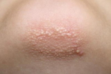 What Causes Those Bumpy Patches